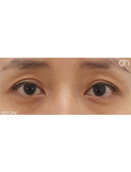 -韩国双眼皮不对称修复推荐喜可整形的眼部脂肪填充手术!