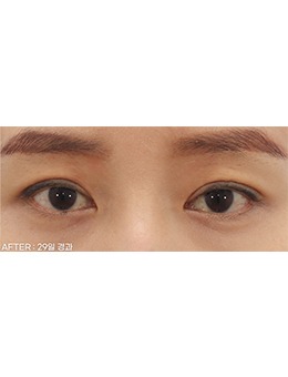 韩国双眼皮不对称修复推荐喜可整形的眼部脂肪填充手术!