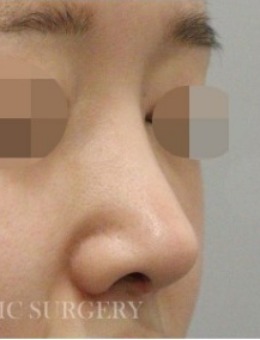 韩国真谈修复鼻子自然吗？术前很假术后很自然！