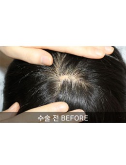 植发后1到8个月效果图，韩国毛莱茵整形医院在线展示！_术前