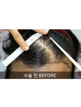 -头发疤痕不长头发怎么办，韩国毛莱茵植发医院帮您解决！