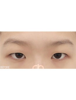 韩国喜可整形做双眼皮好吗？自然粘连双眼皮受欢迎！