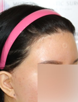 发际线疤痕可以通过植发改变，韩国毛莱茵植发医院生动再现！