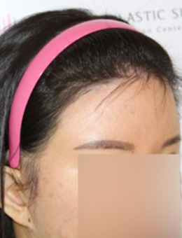 发际线疤痕可以通过植发改变，韩国毛莱茵植发医院生动再现！