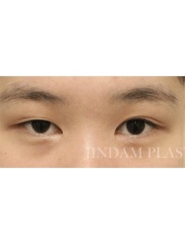 -分享韩国真谈切开法双眼皮+提肌手术矫正眼部不对称！