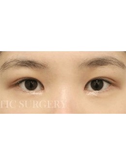 -分享韩国真谈切开法双眼皮+提肌手术矫正眼部不对称！