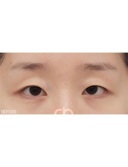 韩国做双眼皮好的医院，喜可整形双眼皮技术备受认可！_术前