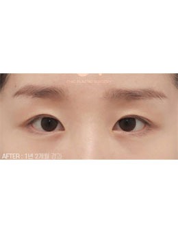 韩国做双眼皮好的医院，喜可整形双眼皮技术备受认可！_术后
