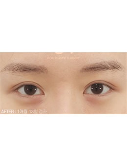 分享我在韩国喜可整形做的双眼皮修复手术，真的太赞了！_术后