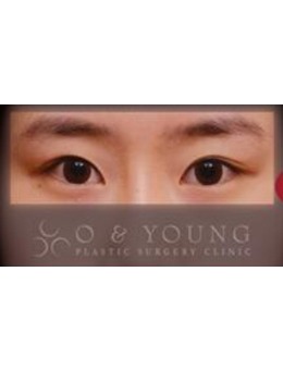 韩国格瑞丝噢爱美整形外科眼部整形对比图