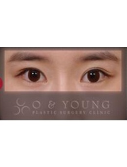 韩国格瑞丝噢爱美整形外科眼部整形对比图_术后