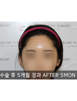 -韩国毛莱茵医院做的发际线植发对比明显！