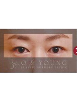 -韩国双眼皮手术比较好的医院做眼睛对比照分享