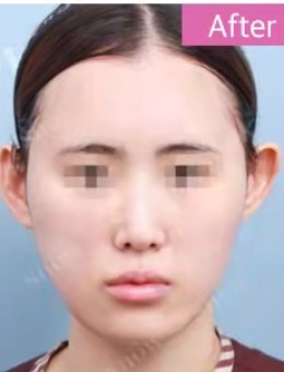 面吸3件套+prp自体脂肪填充竟然有如此惊人的变化！_术后