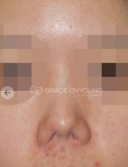 鼻子挛缩修复图片，韩国格瑞丝噢爱美医院为您展示！_术前