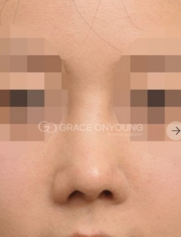 -鼻子挛缩修复图片，韩国格瑞丝噢爱美医院为您展示！