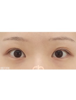 割双眼皮30天恢复效果图，韩国喜可整形医院生动再现！_术前