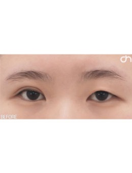 一单一双怎么做双眼皮手术，韩国喜可整形医院在线整活！_术前
