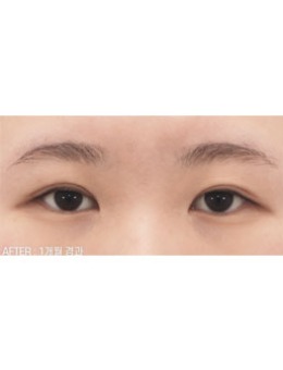 一单一双怎么做双眼皮手术，韩国喜可整形医院在线整活！_术后