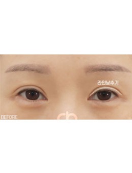 韩国喜可整形医院双眼皮宽改窄修复过程记录！_术前