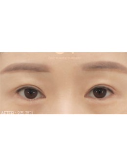 韩国喜可整形医院双眼皮宽改窄修复过程记录！