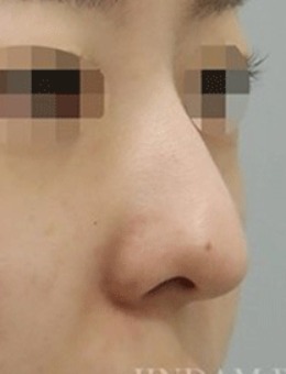 -驼峰鼻+鼻尖矫正，韩国真谈整形真人实例对比图分享！