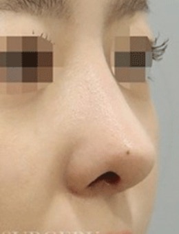-驼峰鼻+鼻尖矫正，韩国真谈整形真人实例对比图分享！