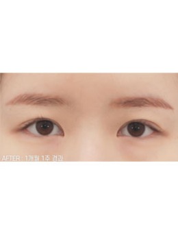 双眼皮疤痕能够修复吗？韩国喜可整形医院眼修复天衣无缝！