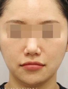 -​韩国真谈做面部吸脂术不错，一起来看看吸脂前后对比照吧！