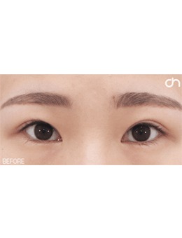 -分享韩国喜可整形外眼角手术后图片，眼白眼球的比例术后更好！