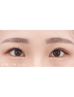 -分享韩国喜可整形外眼角手术后图片，眼白眼球的比例术后更好！