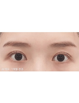 韩国喜可整形除了初眼整形眼修复手术也超级好！！！_术后