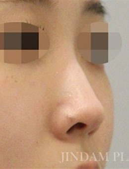 -在韩国真谈整形做的鼻子，术后简直太美了！