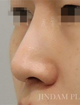 韩国真谈整形男士鼻修复手术日记分享，术后鼻型精致！_术前