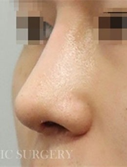 韩国真谈整形男士鼻修复手术日记分享，术后鼻型精致！_术后
