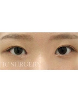 韩国真谈整形眼角修复手术真绝，术后很惊艳！