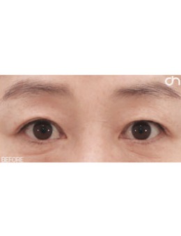 今年50岁了，来韩国喜可整形医院做了双眼皮感觉年轻十岁！
