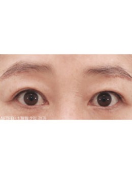 今年50岁了，来韩国喜可整形医院做了双眼皮感觉年轻十岁！_术后