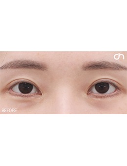 韩国眼修复手术真的能做到疤痕不明显,喜可整形眼修复特别好！_术前