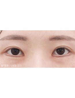 韩国眼修复手术真的能做到疤痕不明显,喜可整形眼修复特别好！_术后