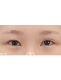 双眼皮不对称怎么调整，韩国喜可整形医院展示修复全过程！