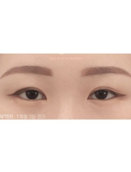 -双眼皮不对称怎么调整，韩国喜可整形医院展示修复全过程！