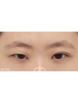 -韩国喜可整形医院一单一双割双眼皮效果案例展示！