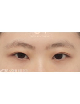 韩国喜可整形医院一单一双割双眼皮效果案例展示！