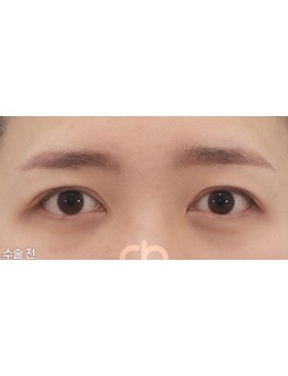 -韩国眼睛修复整形医院就有喜可整形外科，附案例!