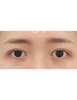 -韩国眼睛修复整形医院就有喜可整形外科，附案例!