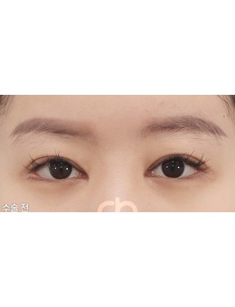 韩国喜可整形外科是内眼角修复好的医院,眼角修复对比图分享!_术前