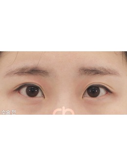  成允植是韩国眼角修复好的整形医生,内眼角修复做得非常好！
