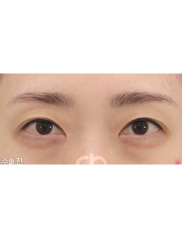 韩国眼角手术出名医生推荐喜可整形外科成允植医生!