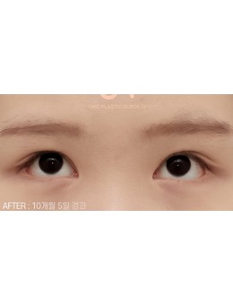 韩国眼角复原内眼角修复就去喜可整形,成允植眼修复做得好!